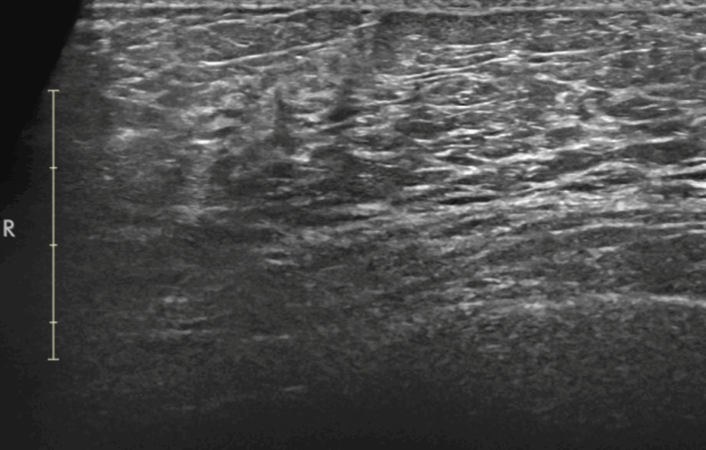 Safe Breast Screening Options Beyond Mammograms