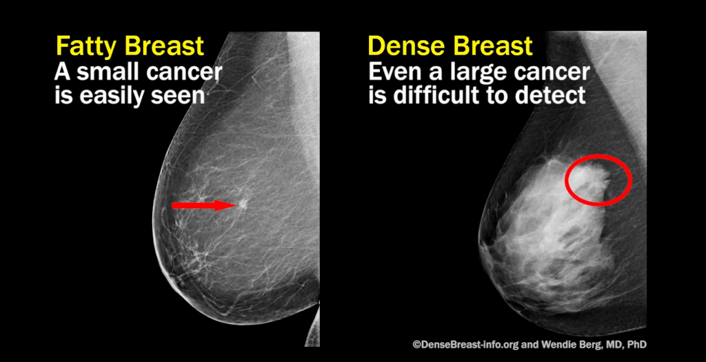 Do Mammograms Miss Cancer on Dense Breasts
