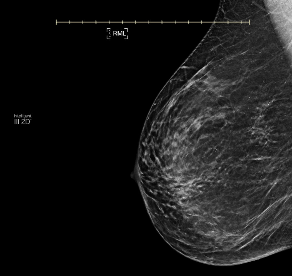 Is DCIS Cancer Calcifications